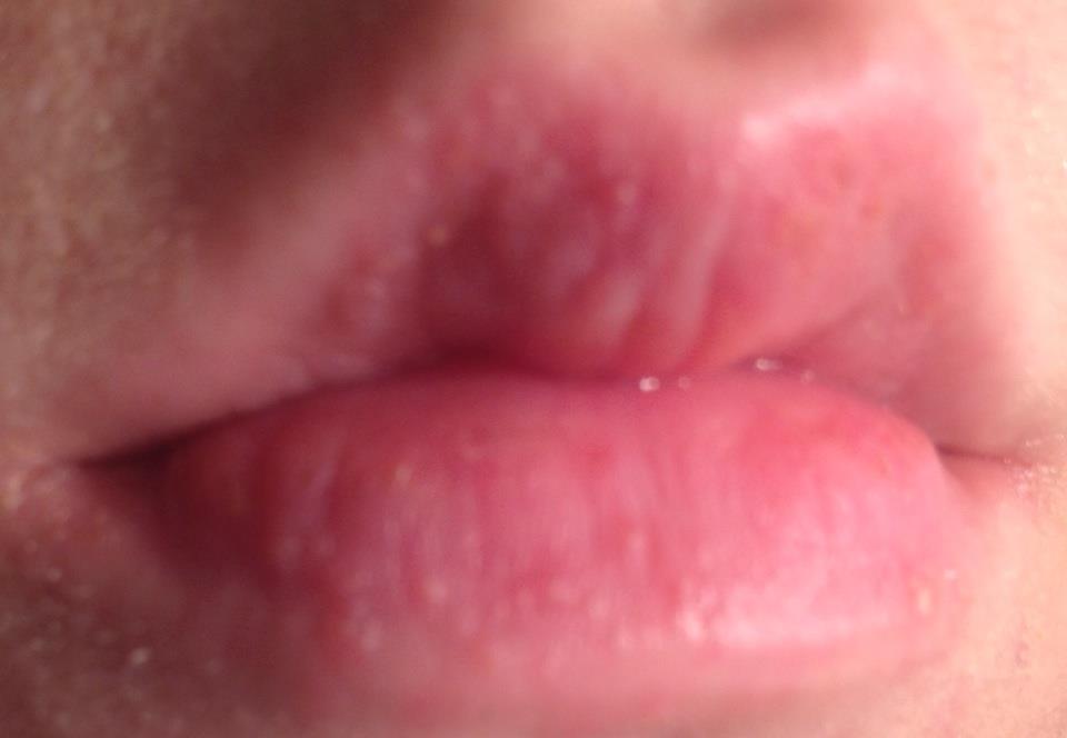 petit bouton sur les levres bouche petit bouton sur les levres bouche